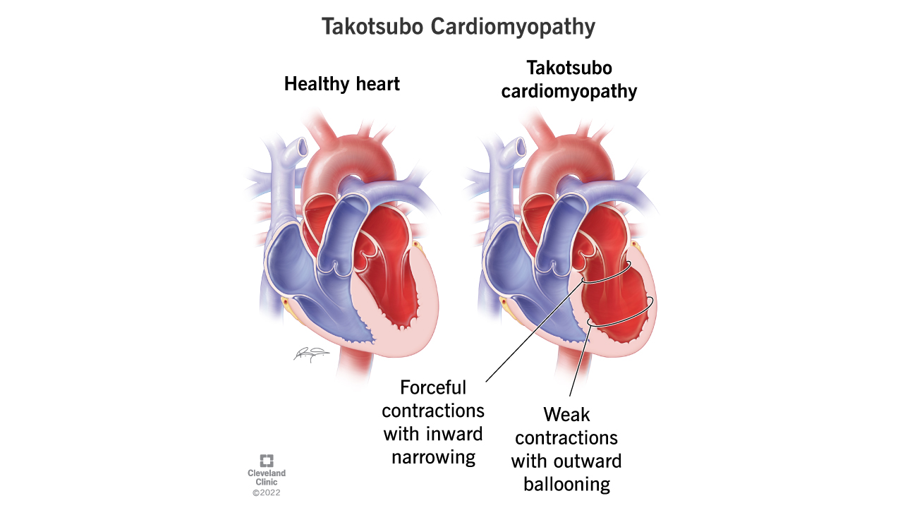 BOB买球平台克利夫兰诊所takotsubo心肌病或心碎综合征的插图。